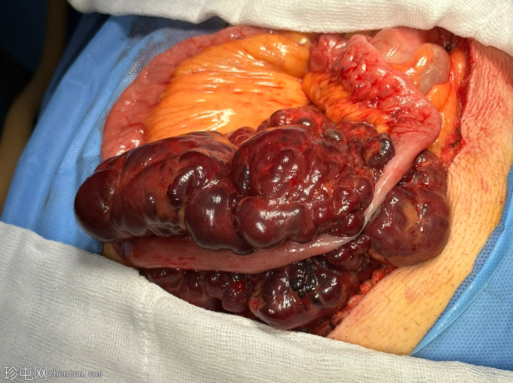 肠系膜囊性淋巴管瘤