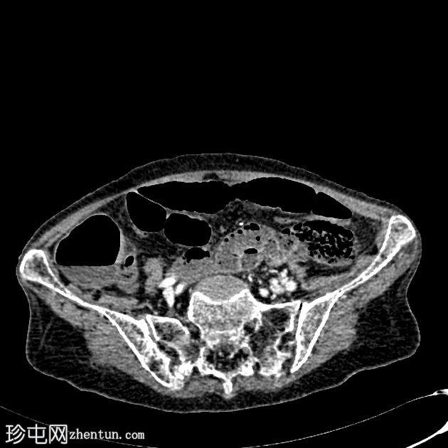 肠系膜上动脉和替代肝右动脉血栓形成