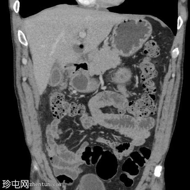 消化性溃疡伴局部穿孔