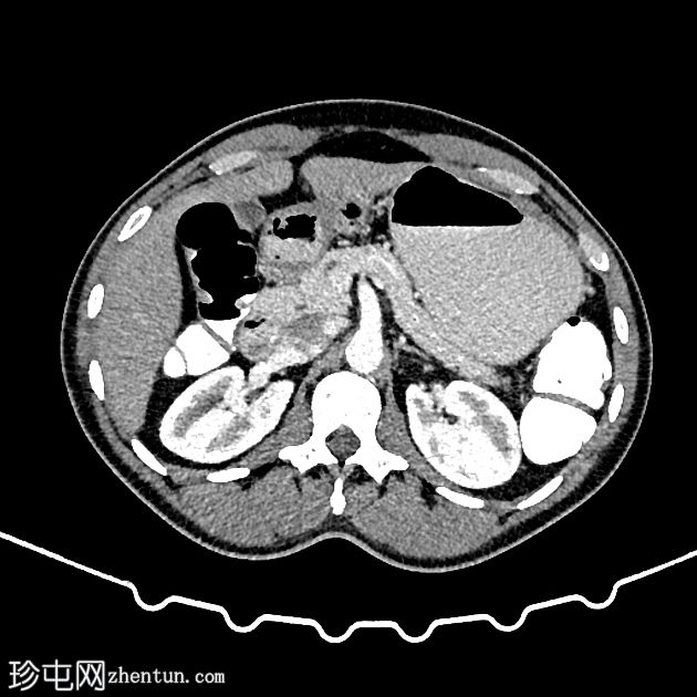 腹腔肠系膜干