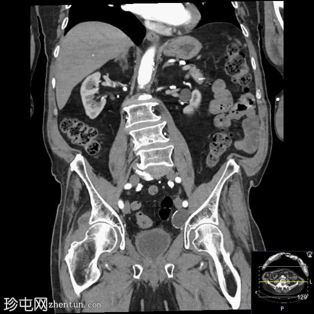 含乙状结肠的腹股沟斜疝