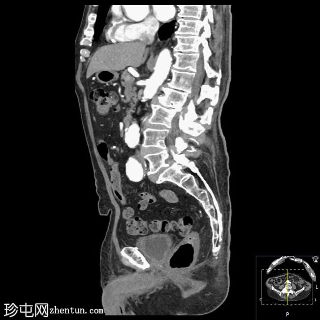 含乙状结肠的腹股沟斜疝