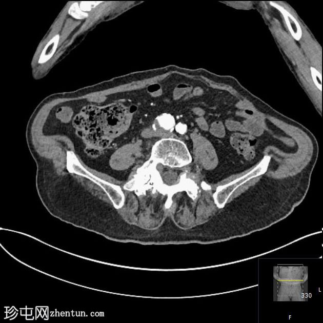 含乙状结肠的腹股沟斜疝