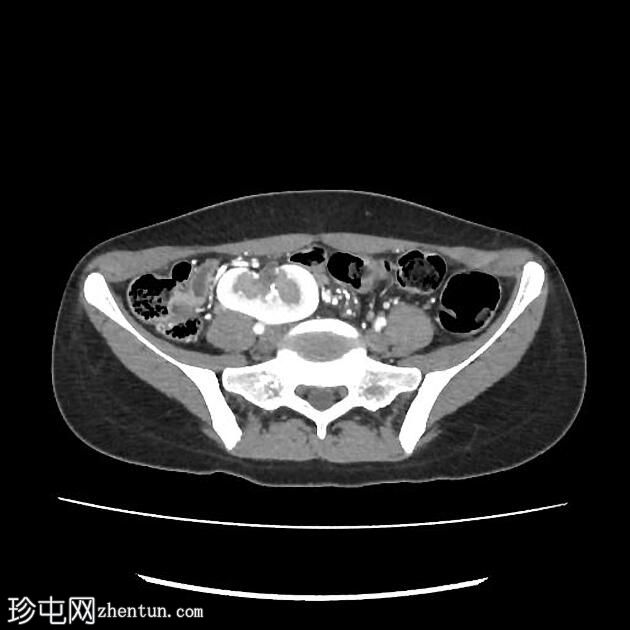 腹膜后副神经节瘤