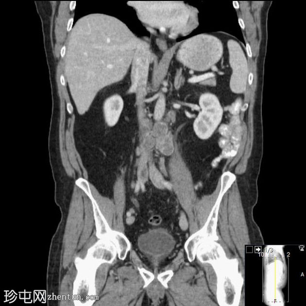 结肠癌转移至淋巴结，包括 Virchow 淋巴结