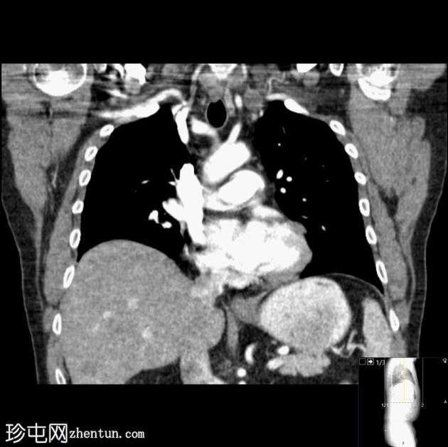 结肠癌转移至淋巴结，包括 Virchow 淋巴结