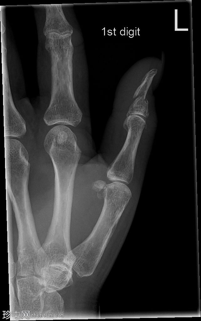 远节指骨骨折 - 拇指