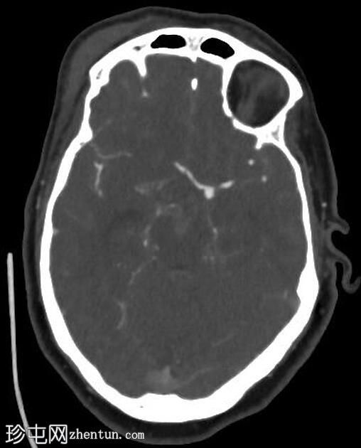 破裂的 ACA (A1) 动脉瘤 - 诊断和治疗