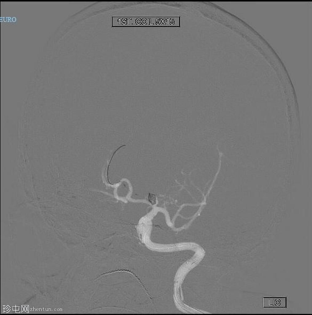 破裂的 ACA (A1) 动脉瘤 - 诊断和治疗