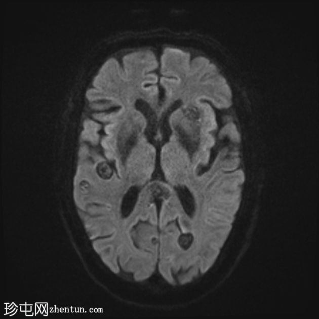 恶性黑色素瘤脑转移