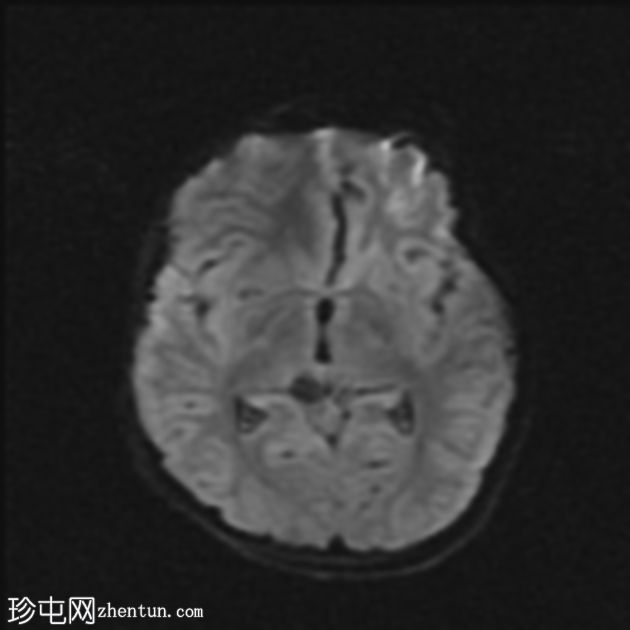 结核性脑膜炎