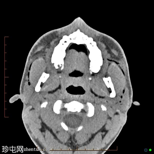 腮腺炎