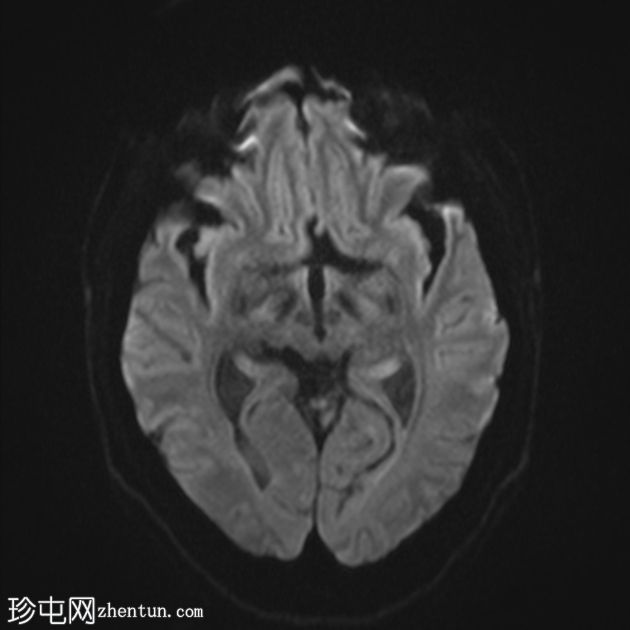 肠型鼻腺癌