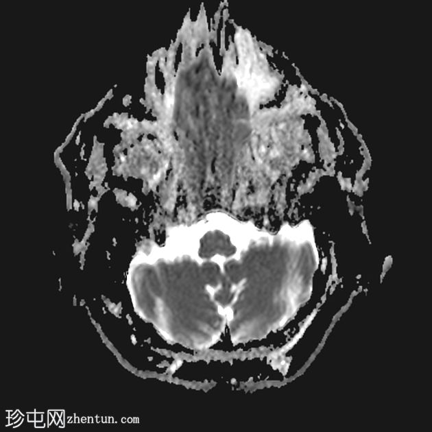 肠型鼻腺癌