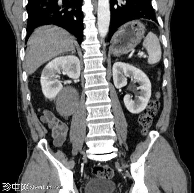 腹膜后包虫囊肿