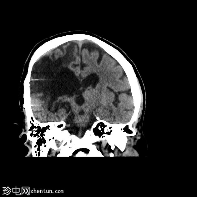 交叉性小脑神经机能障碍