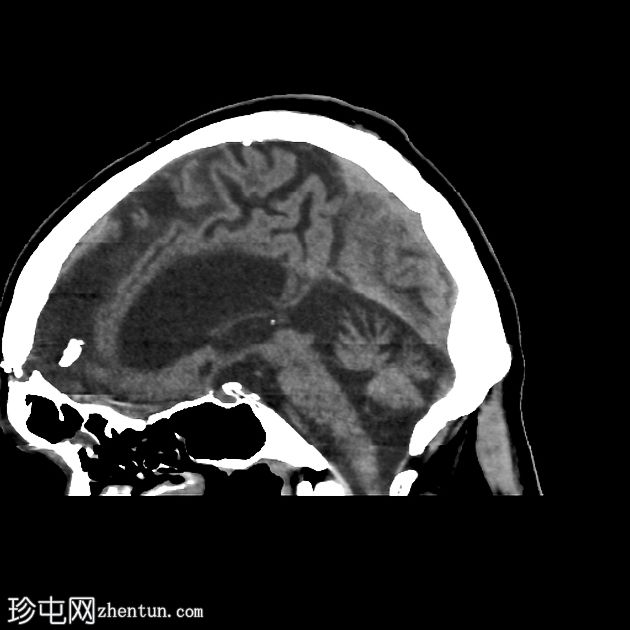 交叉性小脑神经机能障碍