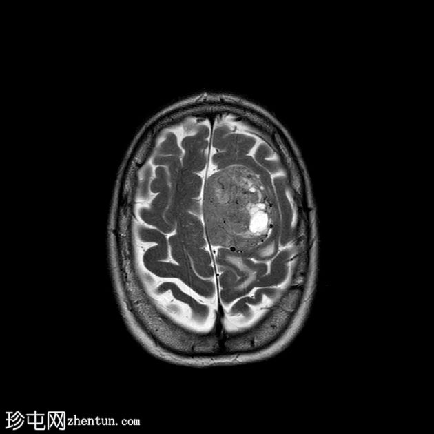 硬脑膜孤立性纤维瘤