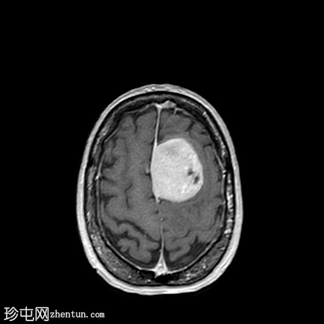 硬脑膜孤立性纤维瘤