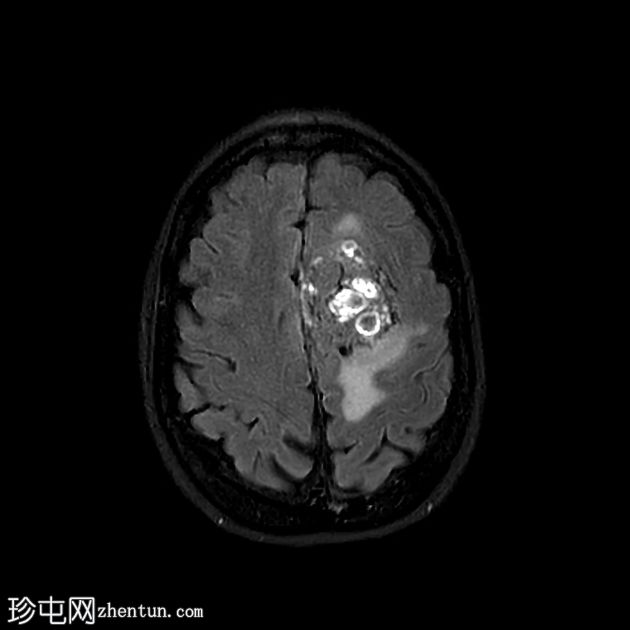 硬脑膜孤立性纤维瘤