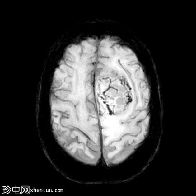 硬脑膜孤立性纤维瘤