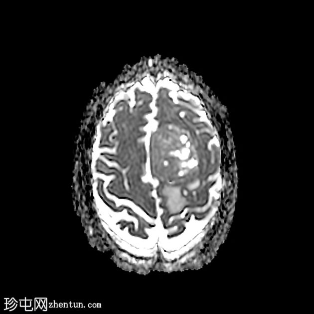 硬脑膜孤立性纤维瘤