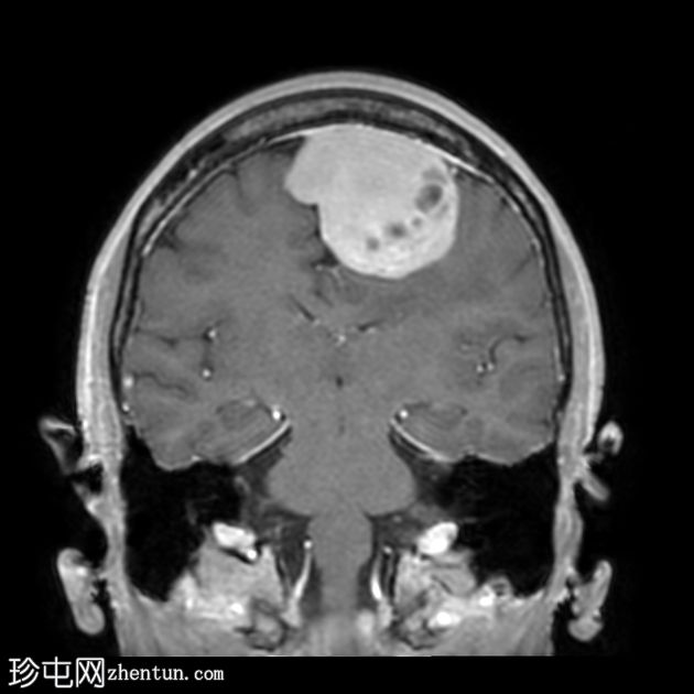 硬脑膜孤立纤维肿瘤