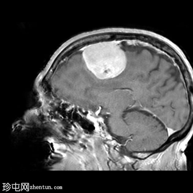 硬脑膜孤立纤维肿瘤