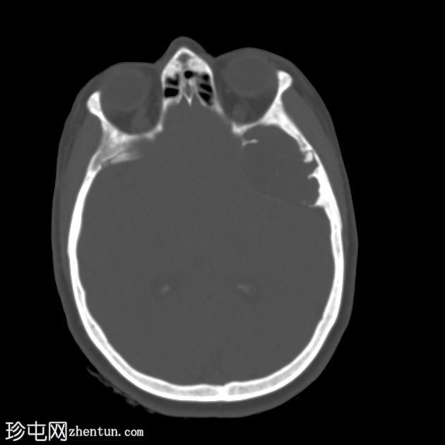 脂肪表皮样囊肿