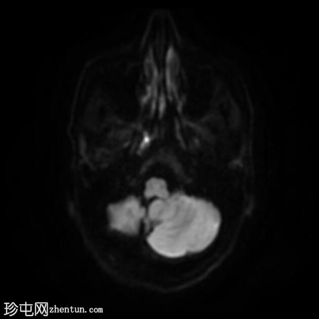 单侧小脑发育不全