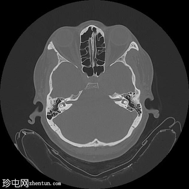 三叉神经的结构瘤