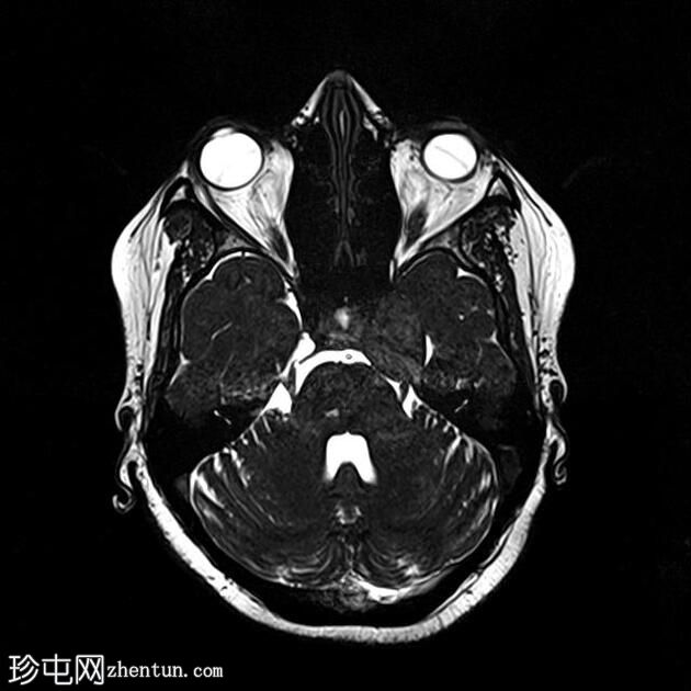 三叉神经的结构瘤