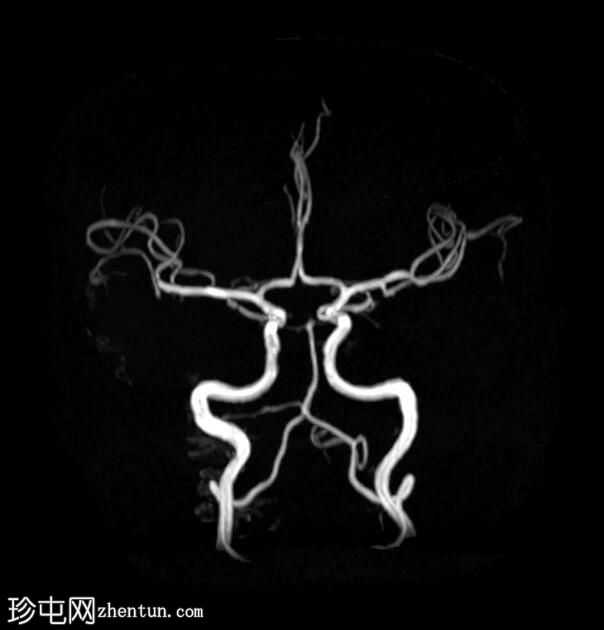 三叉神经的结构瘤