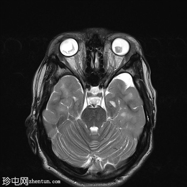 结节硬化