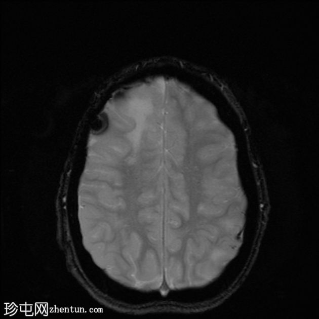 结节硬化