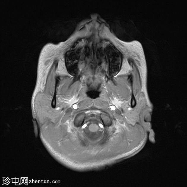 结节硬化