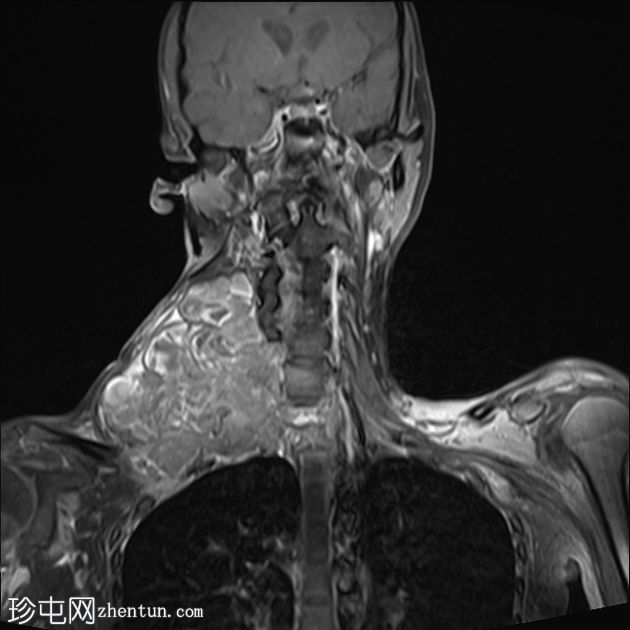 滑膜肉瘤-颈部