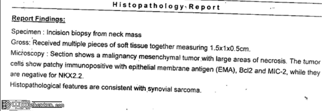滑膜肉瘤-颈部