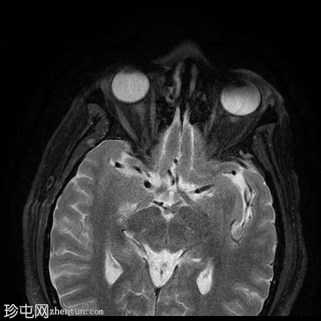 腮腺导管结石及良性淋巴上皮病变