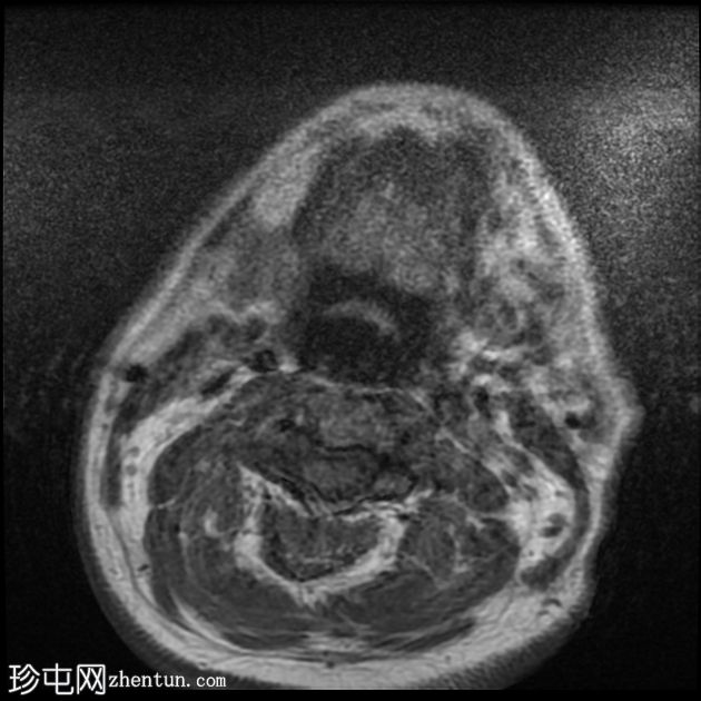 腮腺导管结石及良性淋巴上皮病变