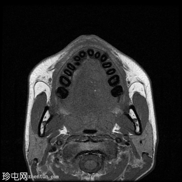 口腔血管瘤