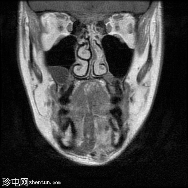 口腔血管瘤