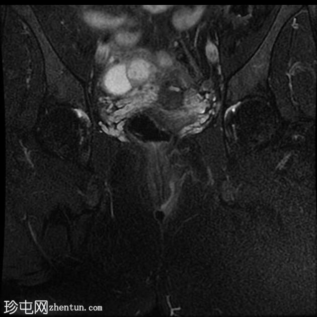 肛周瘘-括约肌间型