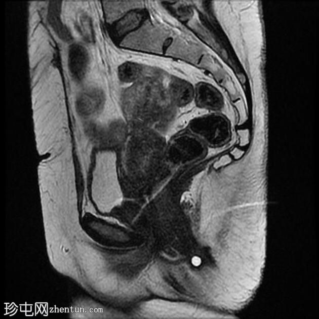 肛周瘘-括约肌间型