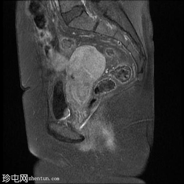 肛周瘘-括约肌间型