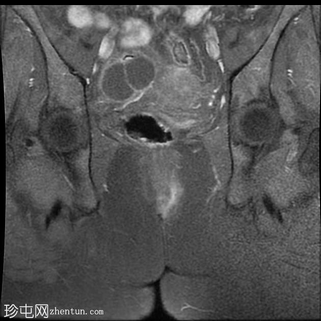 肛周瘘-括约肌间型