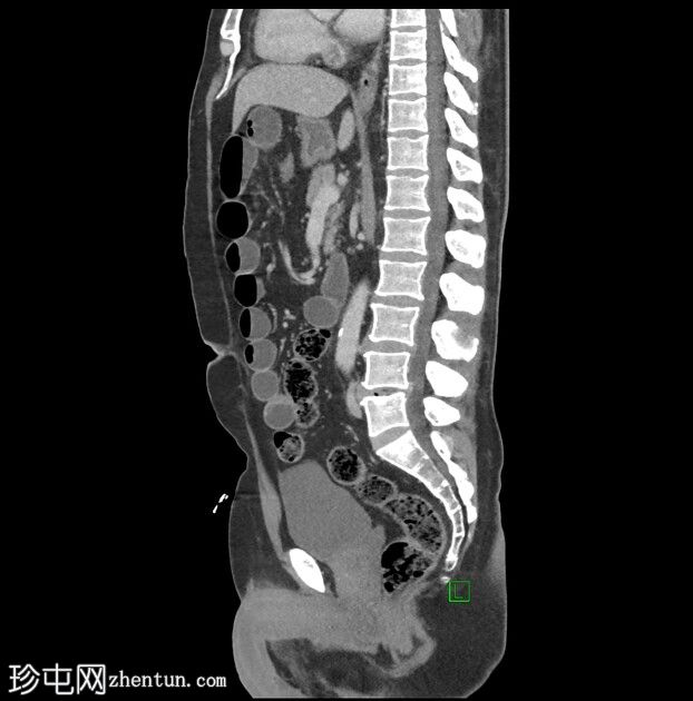 梅克尔憩室炎并发急性小肠梗阻