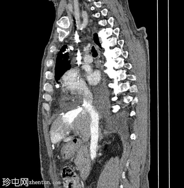 继发于上腔静脉狭窄的肝脏假性病变