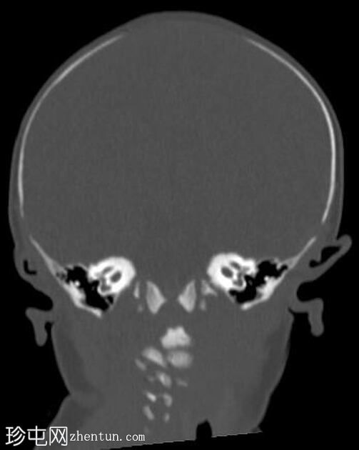 正常新生儿CT头