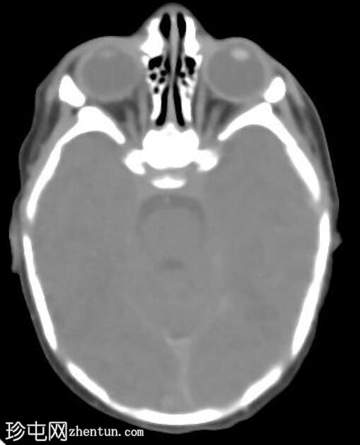 正常新生儿CT头
